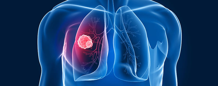 Lung Cancer Prevention & Risk Factors - Dr Sreekanth K