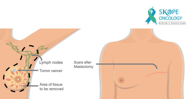 Breast-Conserving Surgery or Mastectomy