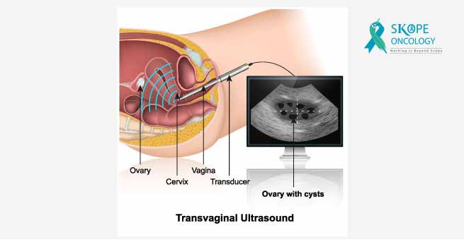 Transvaginal ultrasound (TVUS)