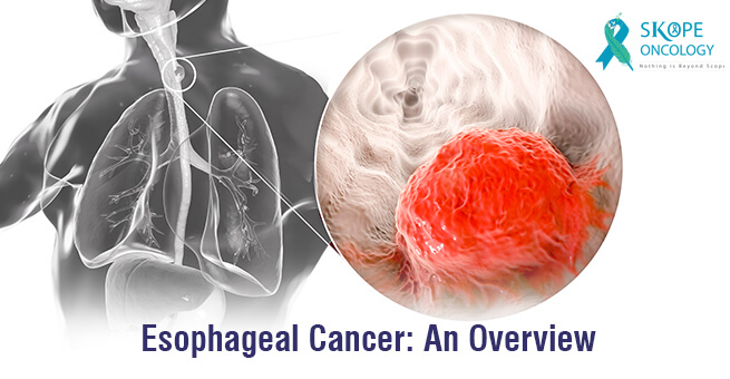 Esophageal Cancer: An overview