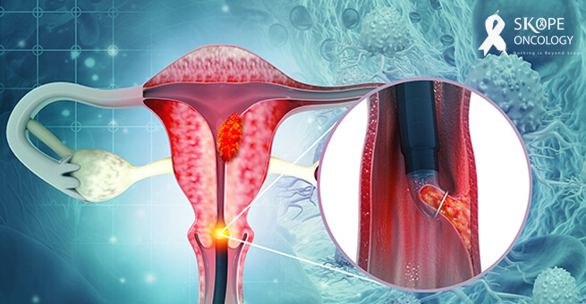 How to detect cervical cancer
