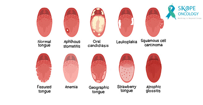 symptoms of tongue cancer