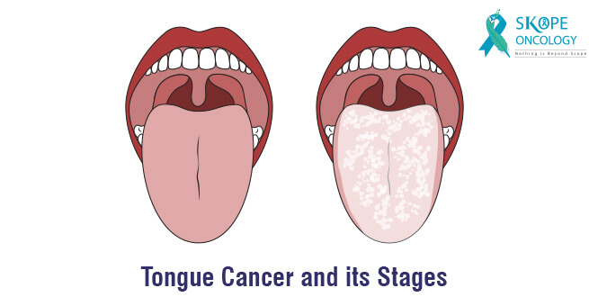 Tongue Cancer and its Stages
