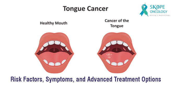 Tongue Cancer: Risk Factors, Symptoms, and Advanced Treatment Options