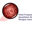Most Frequently Asked Questions About Tongue Cancer