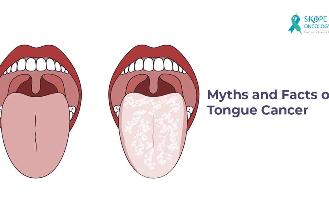 Myths and Facts of Tongue Cancer