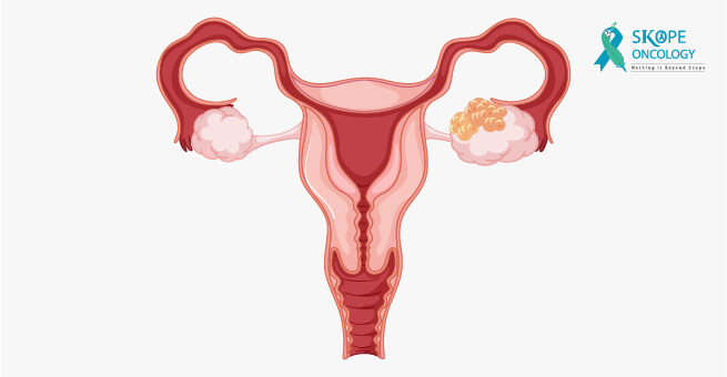Ovarian Cance1